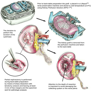 Common Complications after Transplant Surgery