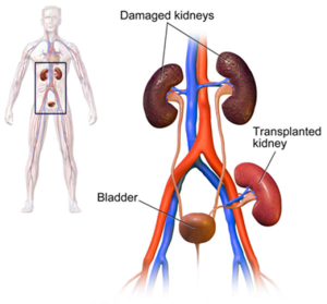 Factors That Influence Life Expectancy After a Kidney Transplant