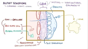 X-linked Alport Syndrome