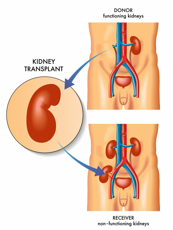 Living vs. Deceased Donor Transplants